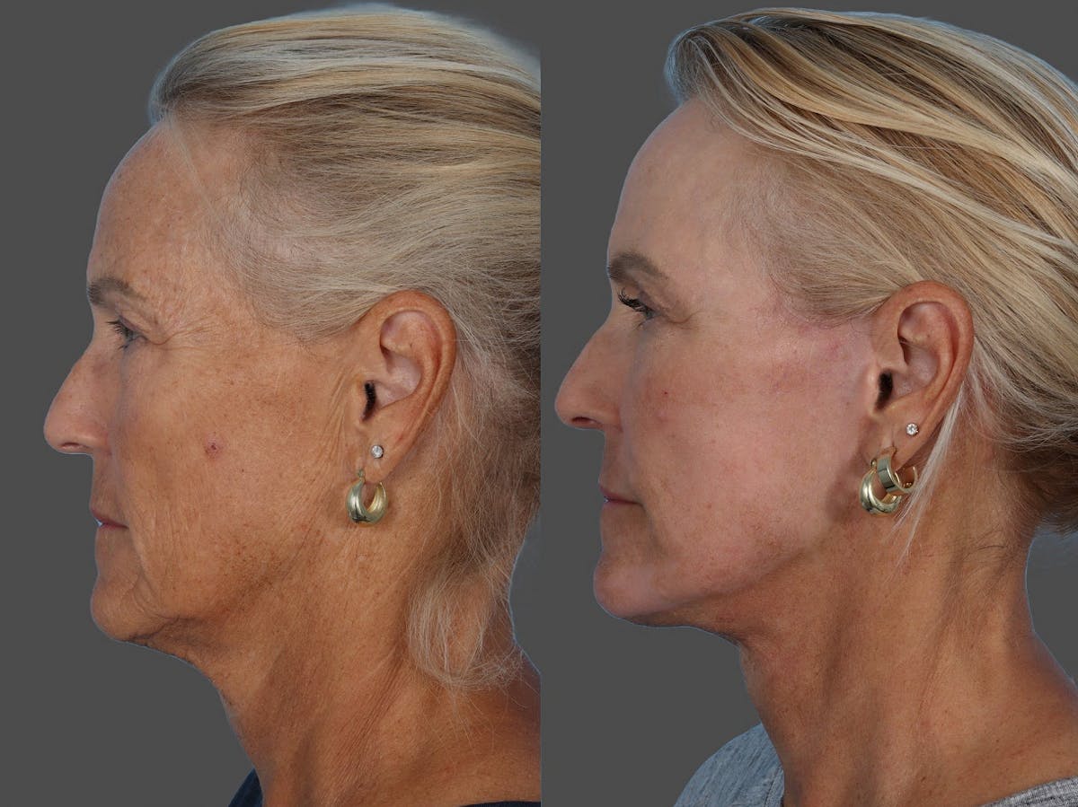 Facial Fat Transfer Before & After Gallery - Patient 138398 - Image 5