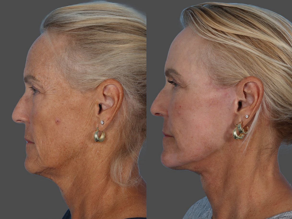 CO2 Fractional Laser Before & After Gallery - Patient 180301 - Image 5