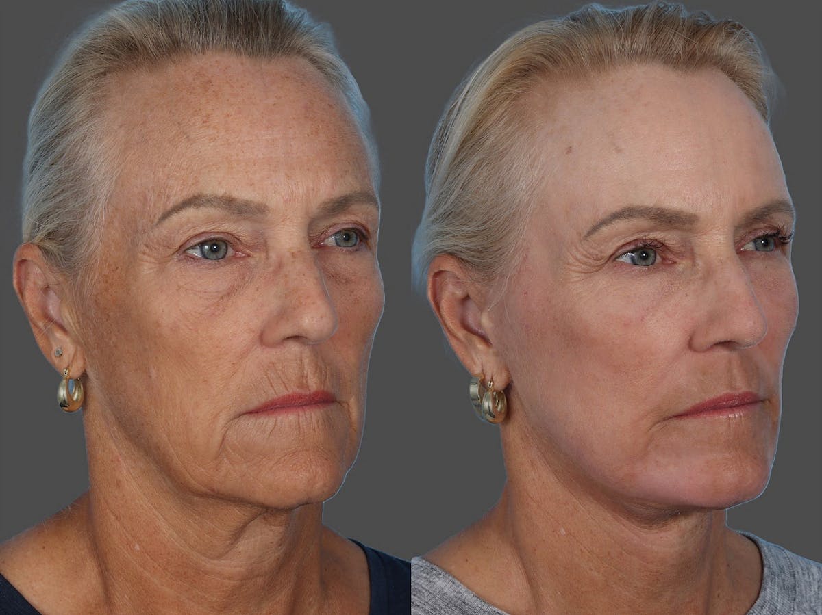 Facial Fat Transfer Before & After Gallery - Patient 138398 - Image 2