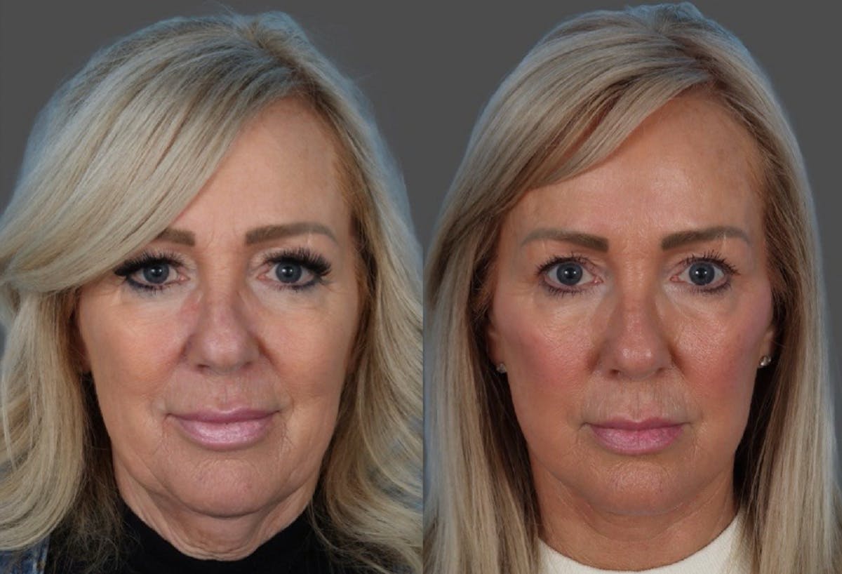 Facial Fat Transfer Before & After Gallery - Patient 255119 - Image 1