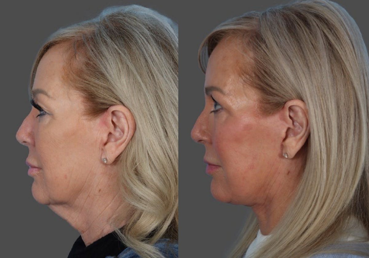 Facial Fat Transfer Before & After Gallery - Patient 255119 - Image 5