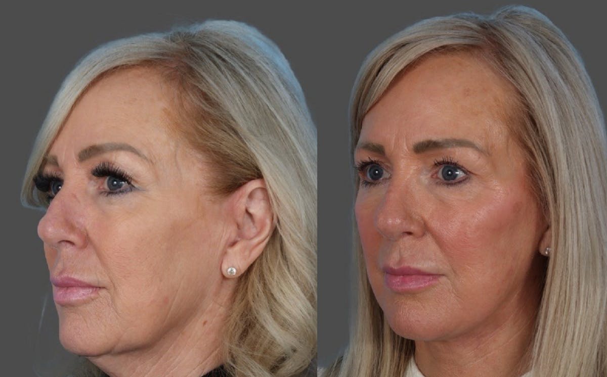 Facial Fat Transfer Before & After Gallery - Patient 255119 - Image 4