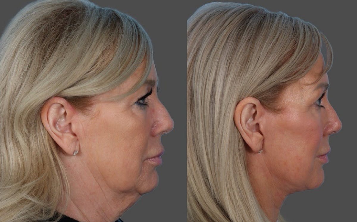 Facial Fat Transfer Before & After Gallery - Patient 255119 - Image 3