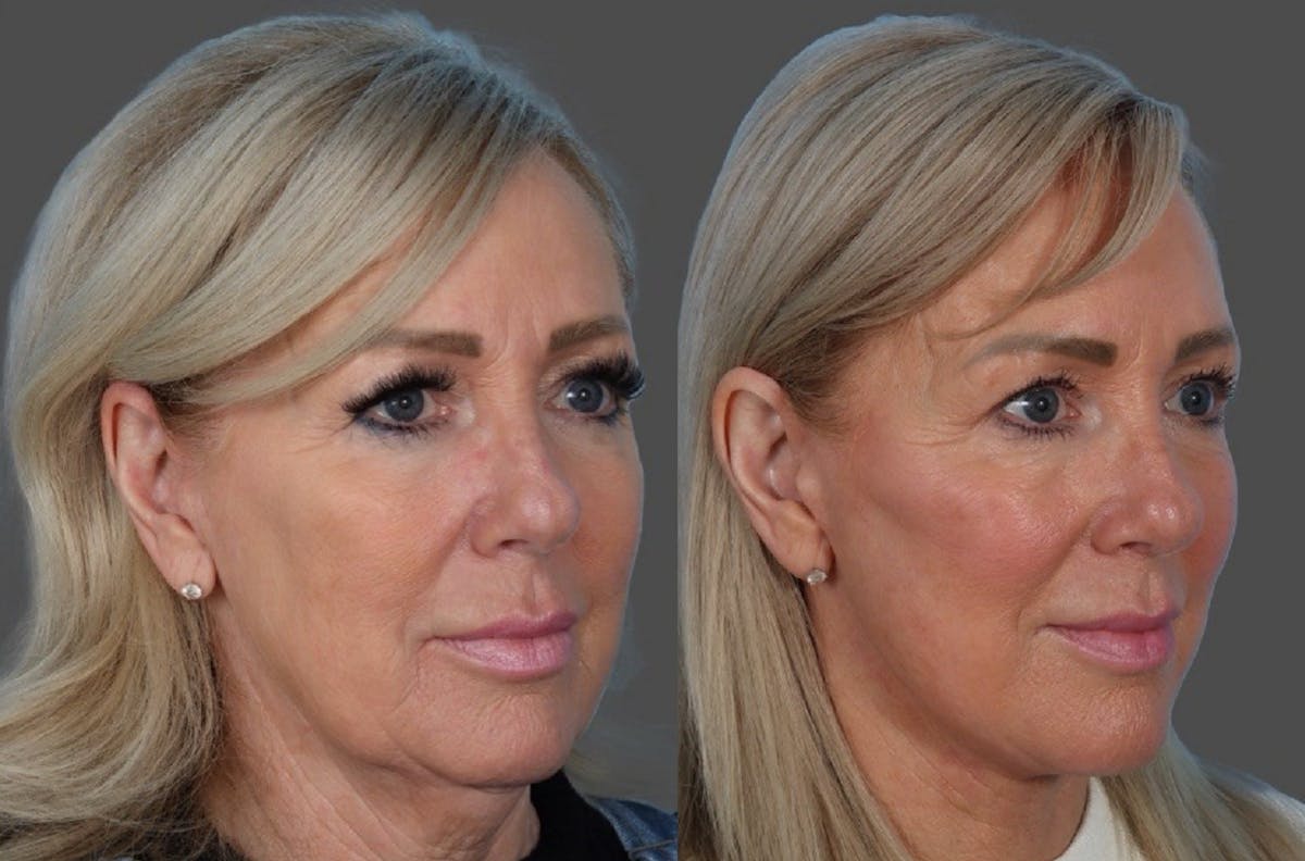 Facial Fat Transfer Before & After Gallery - Patient 255119 - Image 2