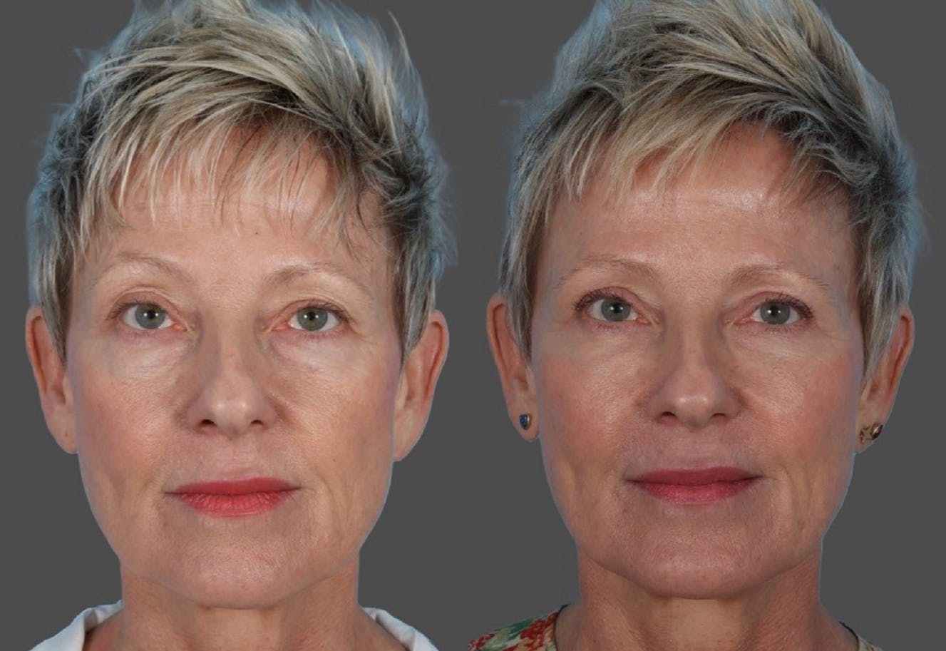 Facial Fat Transfer Before & After Gallery - Patient 214825 - Image 1