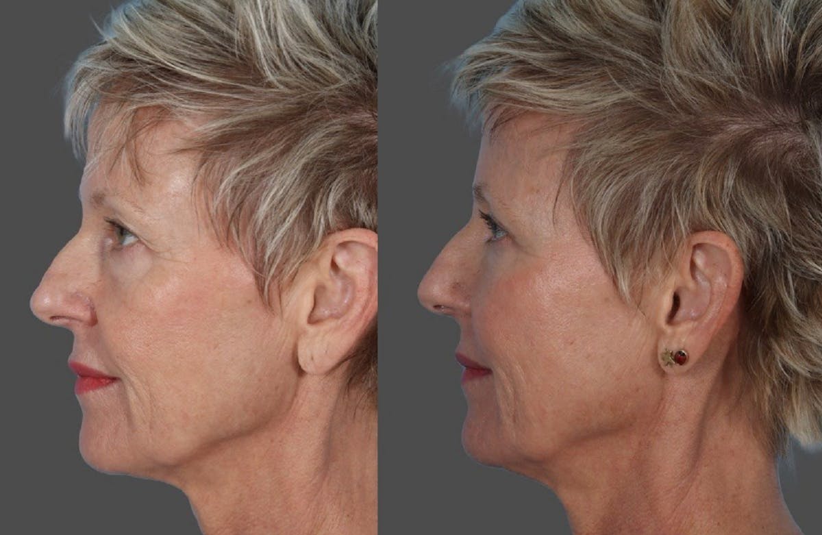 Facial Fat Transfer Before & After Gallery - Patient 214825 - Image 5