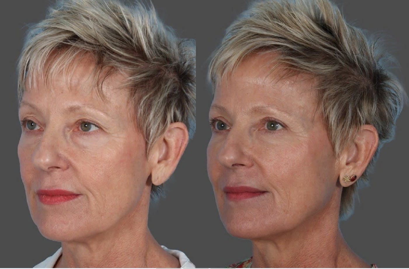 Facial Fat Transfer Before & After Gallery - Patient 214825 - Image 4