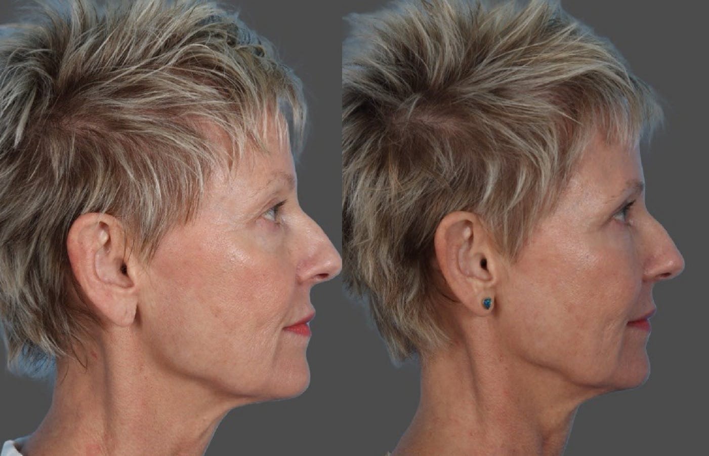 Facial Fat Transfer Before & After Gallery - Patient 214825 - Image 3