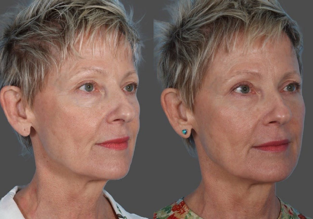 Facial Fat Transfer Before & After Gallery - Patient 214825 - Image 2