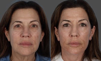 Facelift Before & After Gallery - Patient 891164 - Image 1