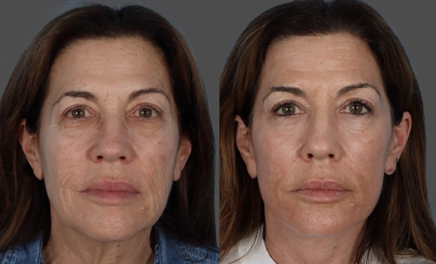 CO2 Fractional Laser Before & After Gallery - Patient 282631 - Image 1