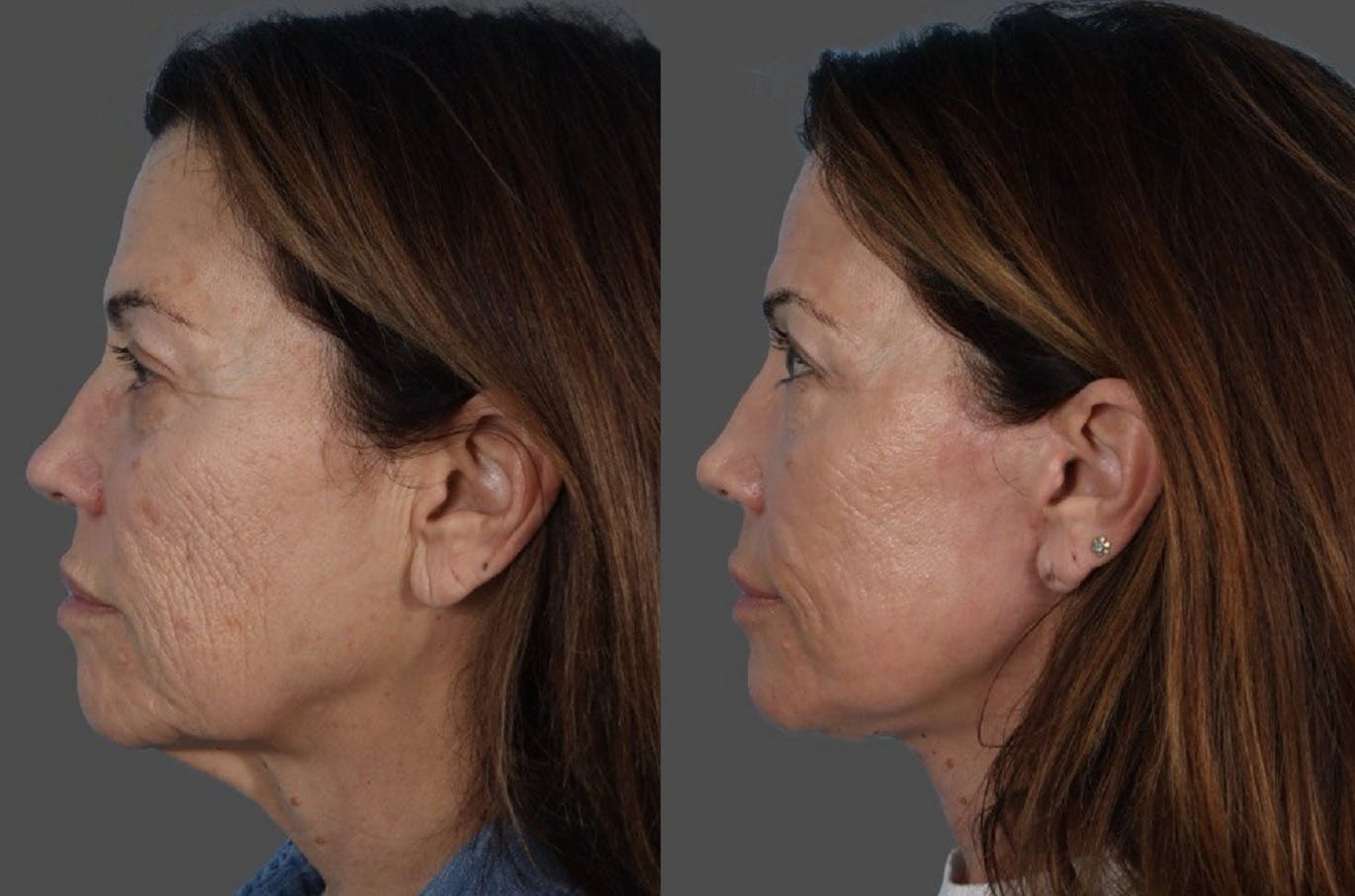 CO2 Fractional Laser Before & After Gallery - Patient 282631 - Image 5