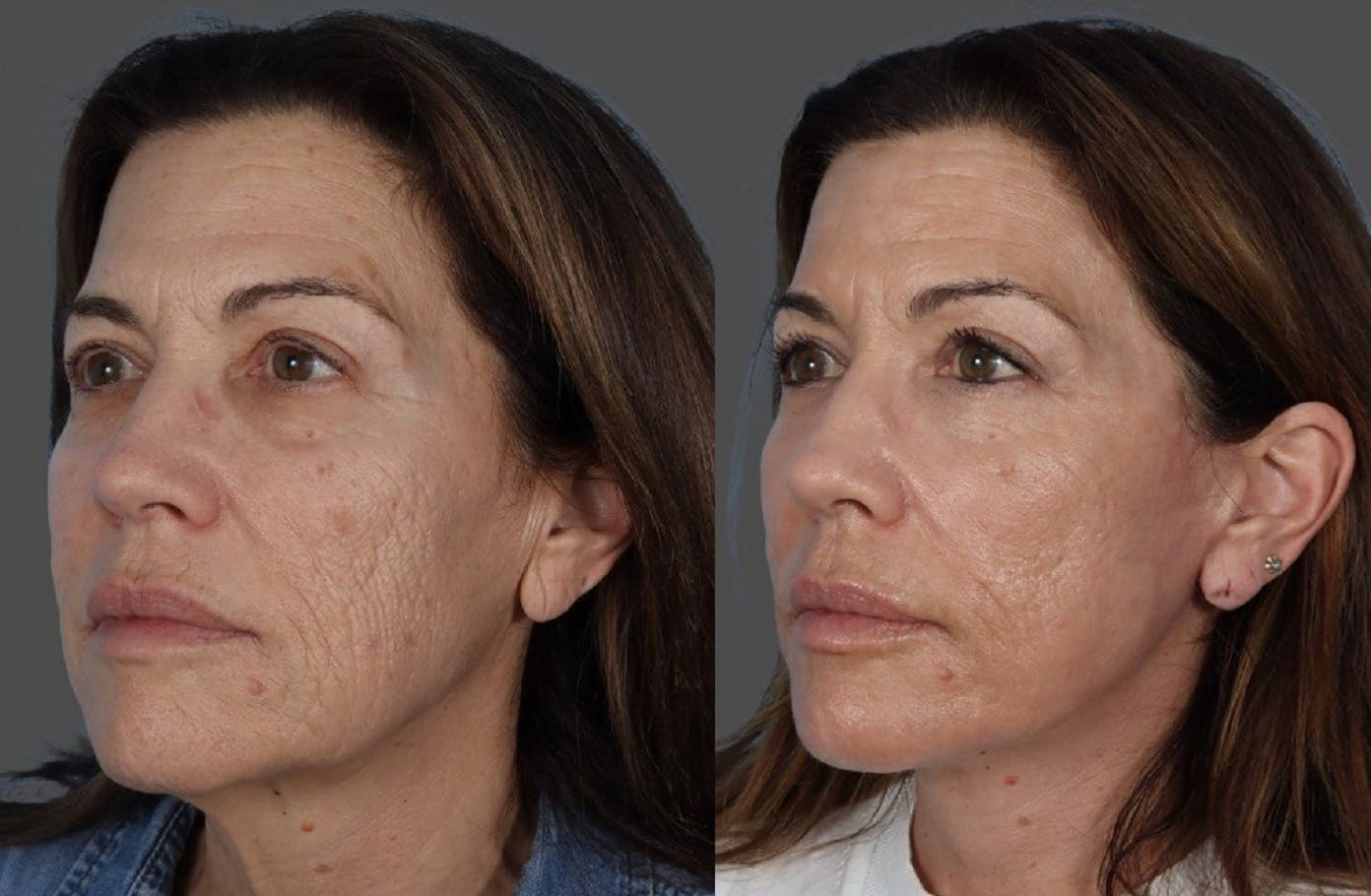 CO2 Fractional Laser Before & After Gallery - Patient 282631 - Image 4