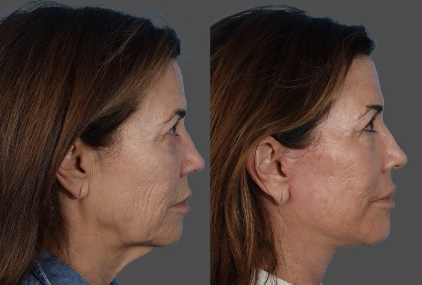 CO2 Fractional Laser Before & After Gallery - Patient 282631 - Image 3