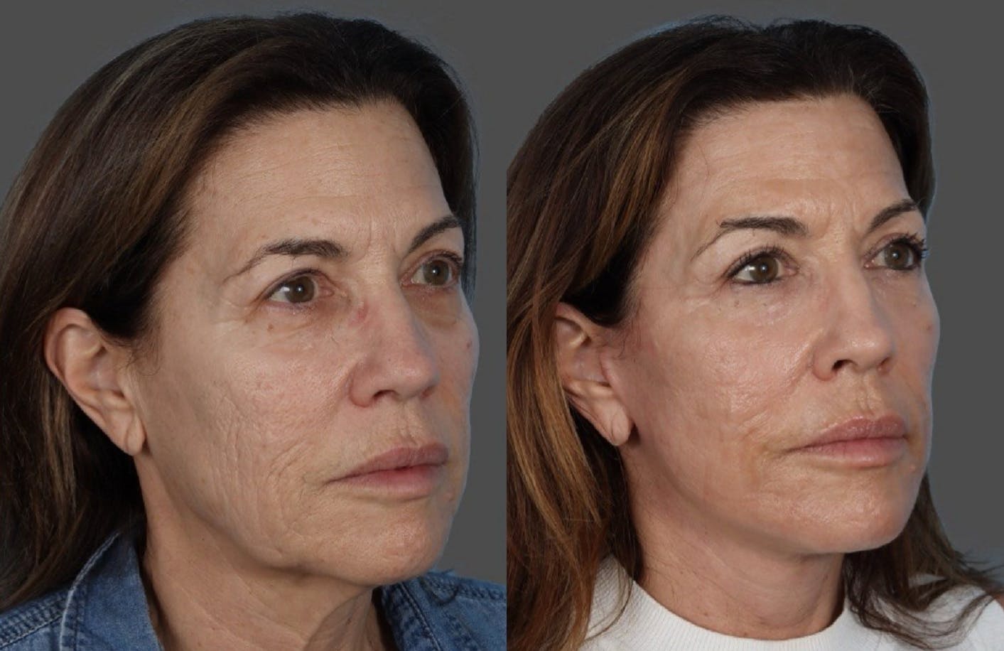 CO2 Fractional Laser Before & After Gallery - Patient 282631 - Image 2