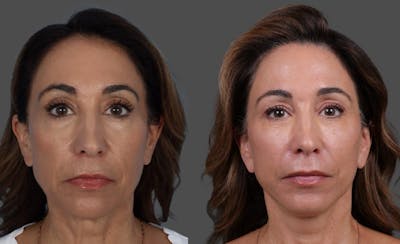 Limited Incision Facelift Before & After Gallery - Patient 308679 - Image 1