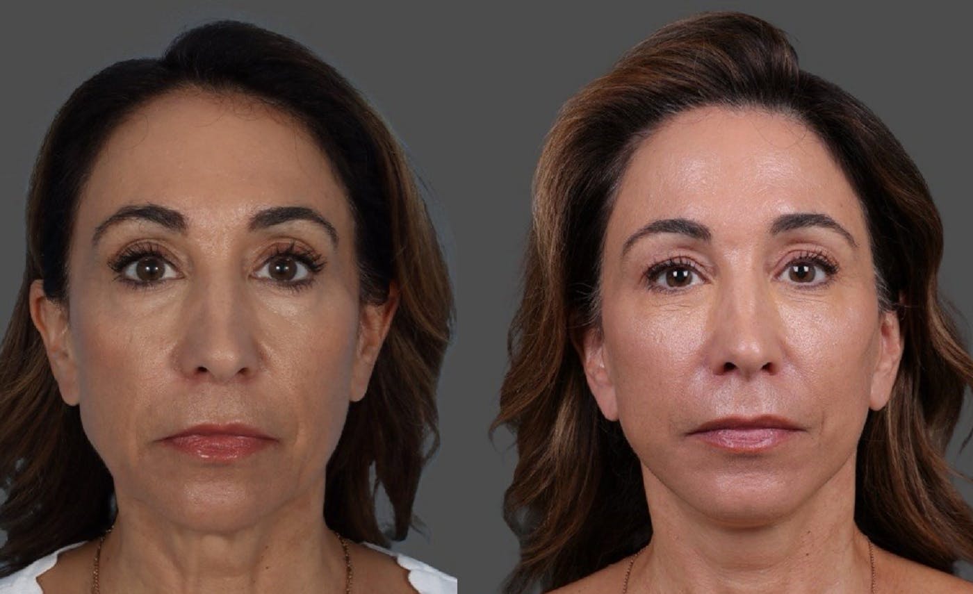 Limited Incision Facelift Before & After Gallery - Patient 308679 - Image 1