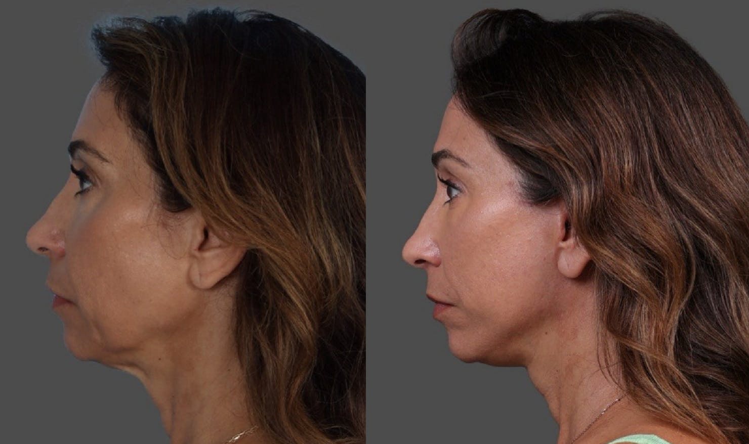 Limited Incision Facelift Before & After Gallery - Patient 308679 - Image 5