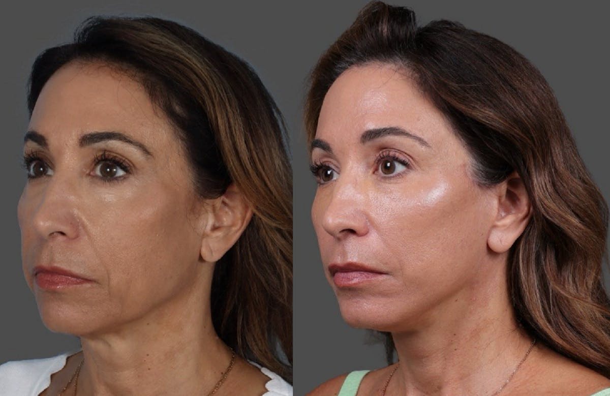 Limited Incision Facelift Before & After Gallery - Patient 308679 - Image 4