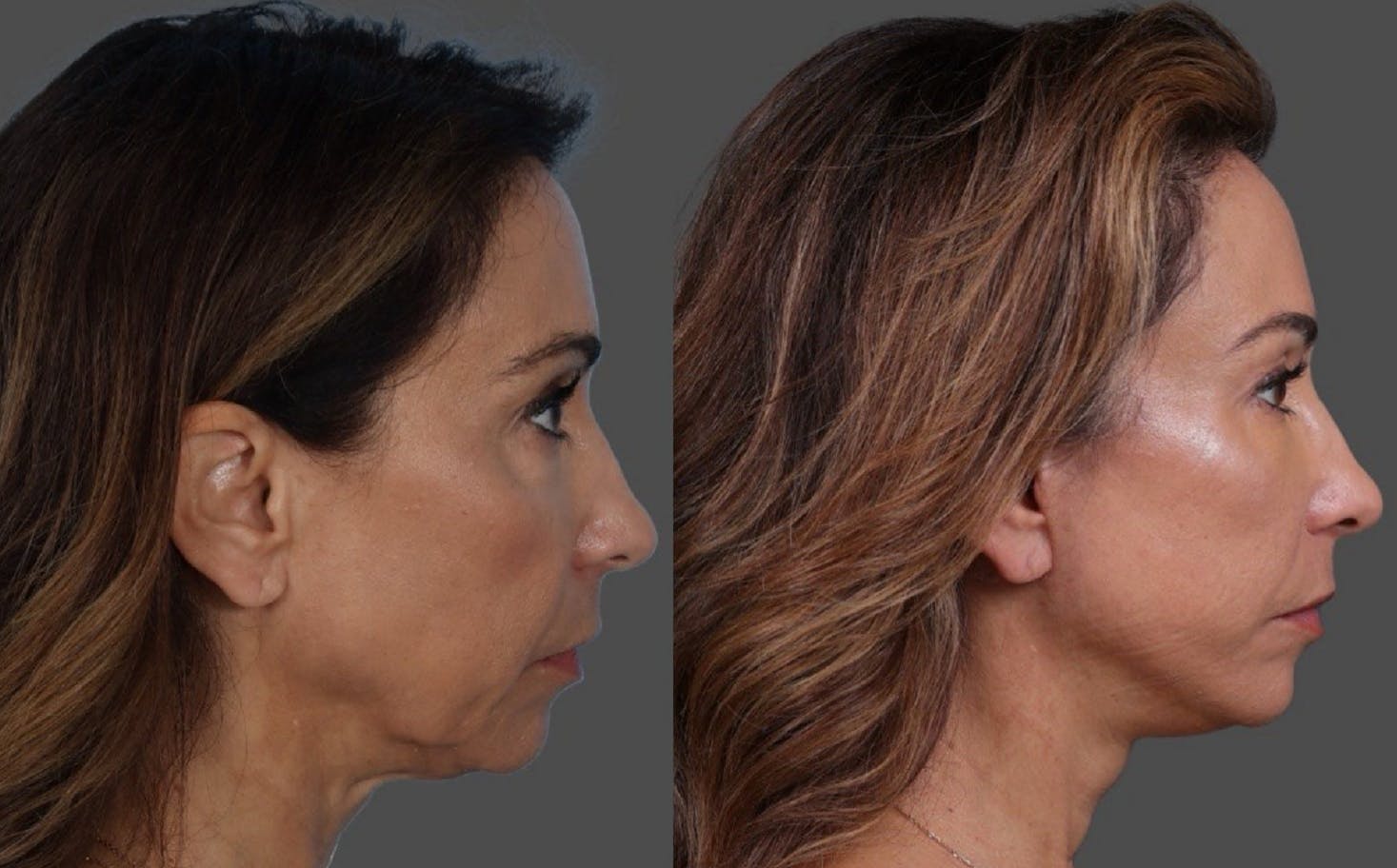Limited Incision Facelift Before & After Gallery - Patient 308679 - Image 3