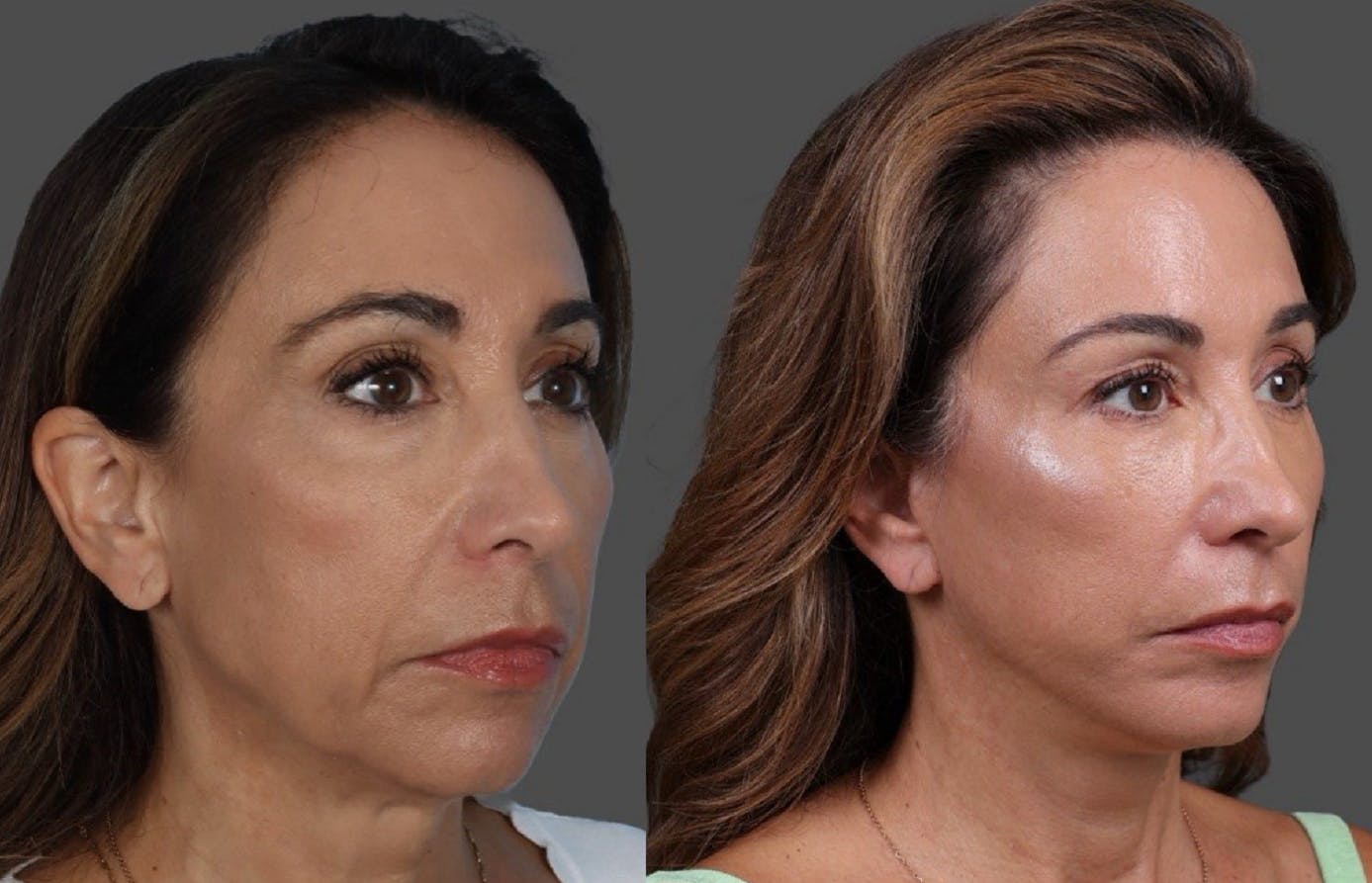 Limited Incision Facelift Before & After Gallery - Patient 308679 - Image 2