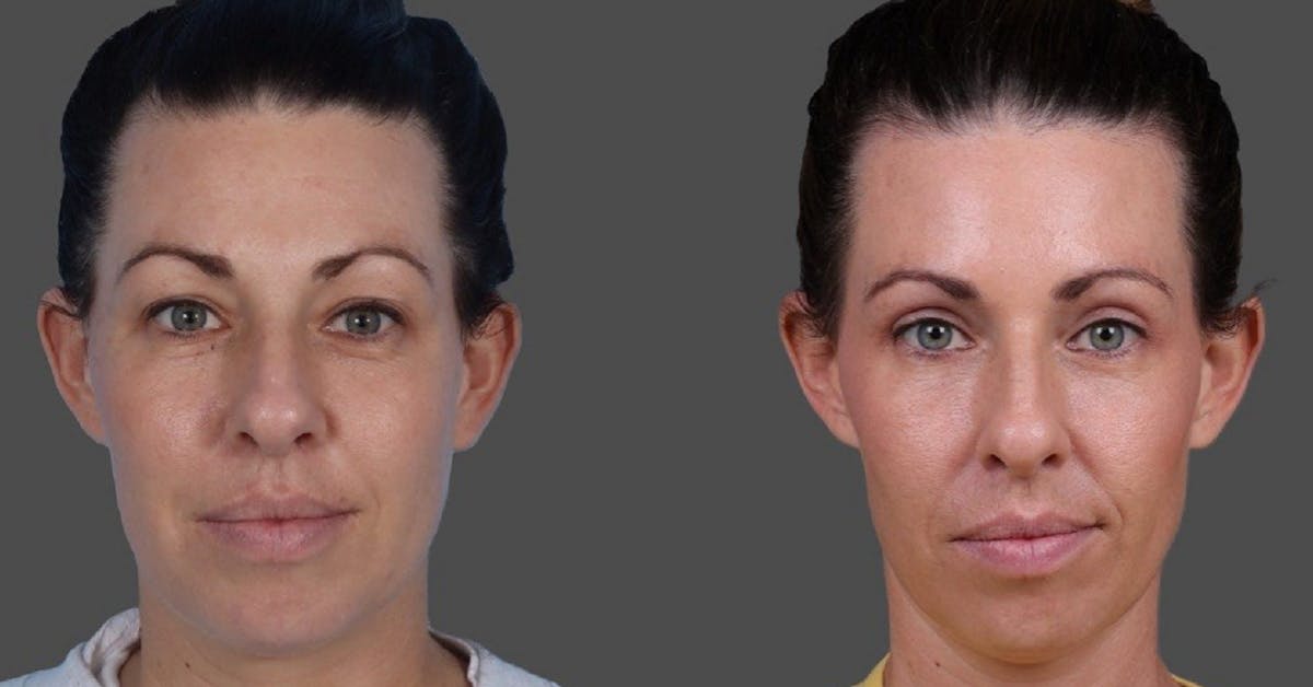 Eyelid Surgery (Blepharoplasty) Before & After Gallery - Patient 111191 - Image 1