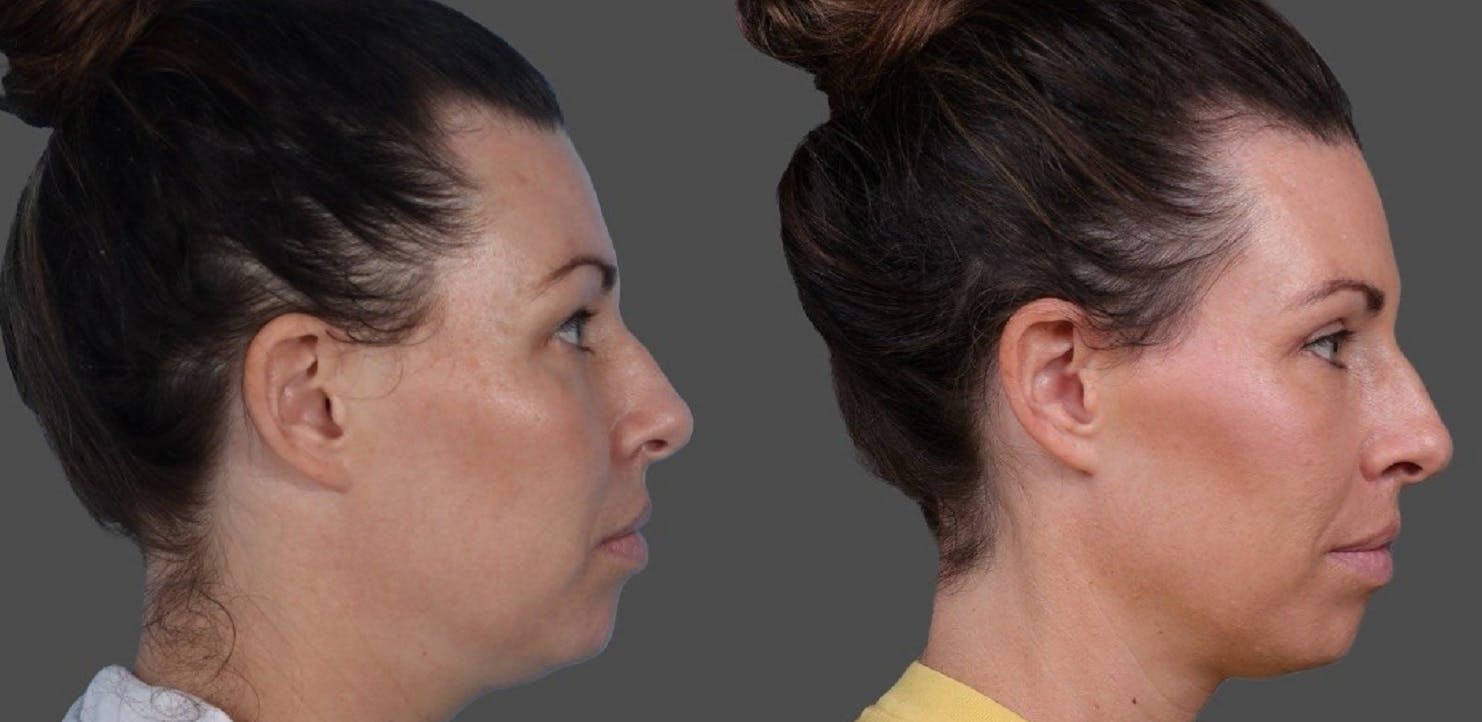 Eyelid Surgery (Blepharoplasty) Before & After Gallery - Patient 111191 - Image 3