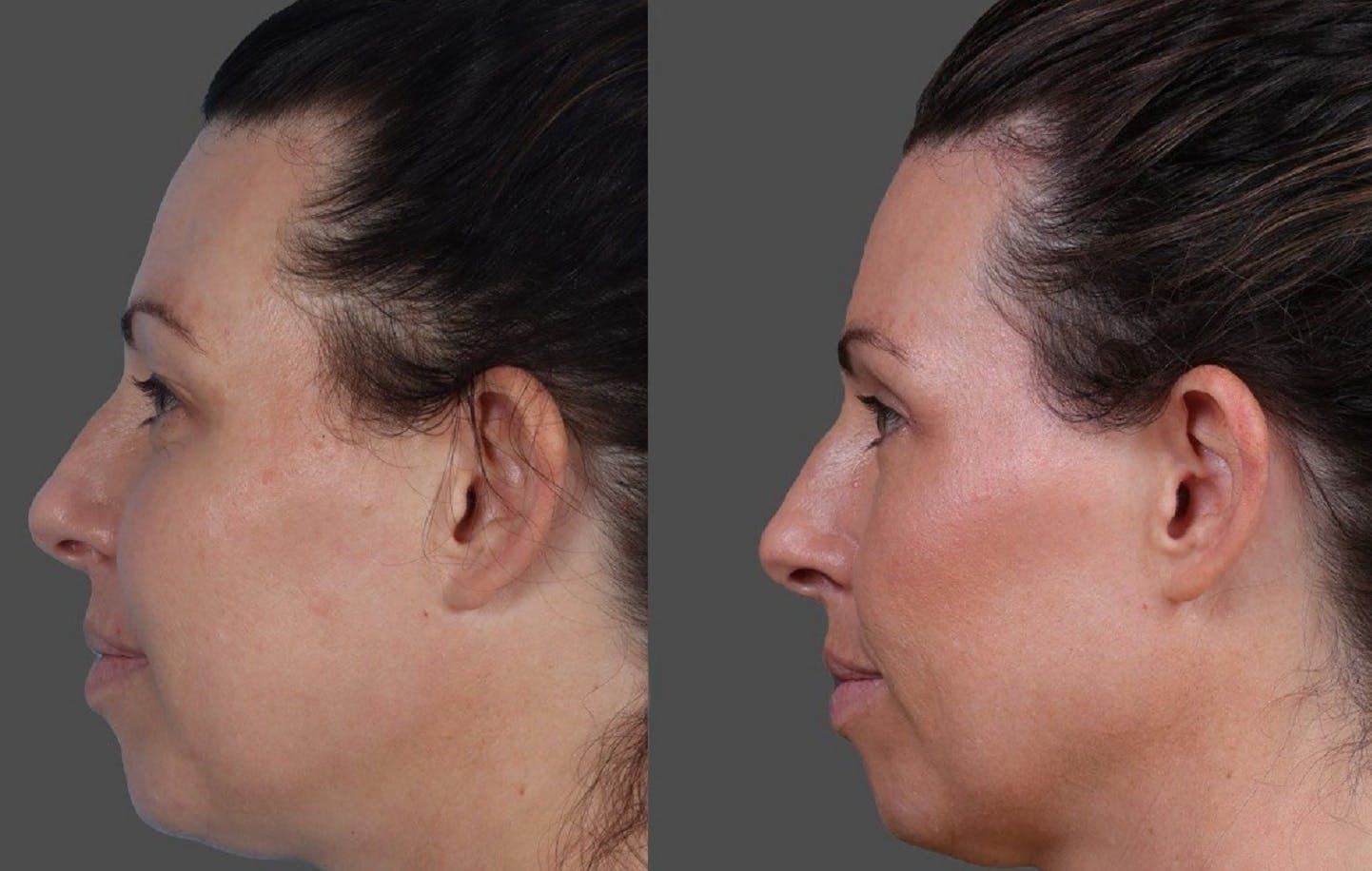 Eyelid Surgery (Blepharoplasty) Before & After Gallery - Patient 111191 - Image 5