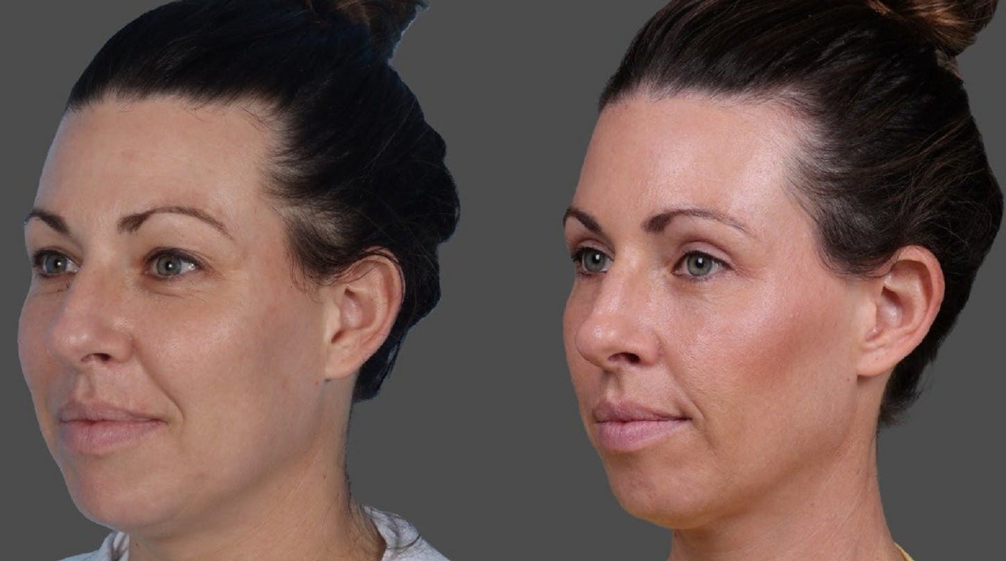 Eyelid Surgery (Blepharoplasty) Before & After Gallery - Patient 111191 - Image 4