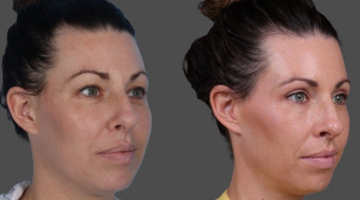 Eyelid Surgery (Blepharoplasty) Before & After Gallery - Patient 111191 - Image 2