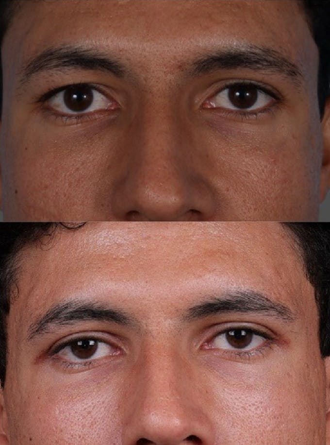 Eyelid Surgery (Blepharoplasty) Before & After Gallery - Patient 178420 - Image 6