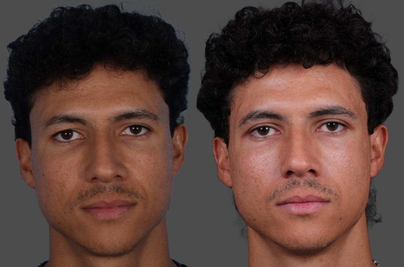 Eyelid Surgery (Blepharoplasty) Before & After Gallery - Patient 178420 - Image 1