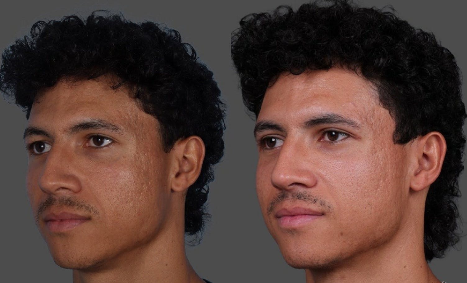 Eyelid Surgery (Blepharoplasty) Before & After Gallery - Patient 178420 - Image 4