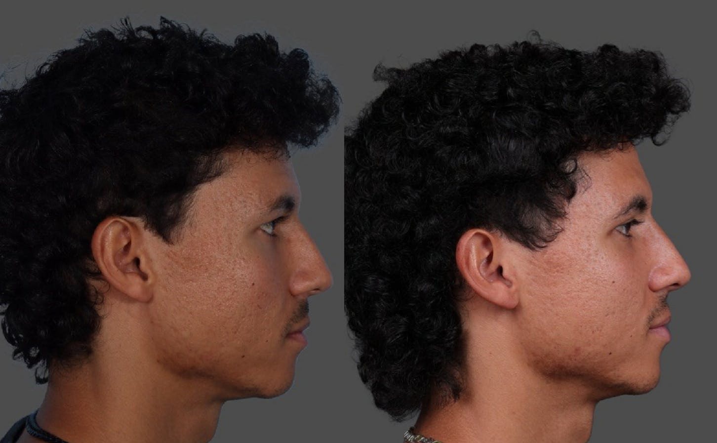 Eyelid Surgery (Blepharoplasty) Before & After Gallery - Patient 178420 - Image 3