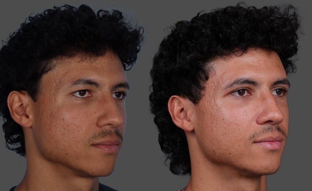 Eyelid Surgery (Blepharoplasty) Before & After Gallery - Patient 178420 - Image 2