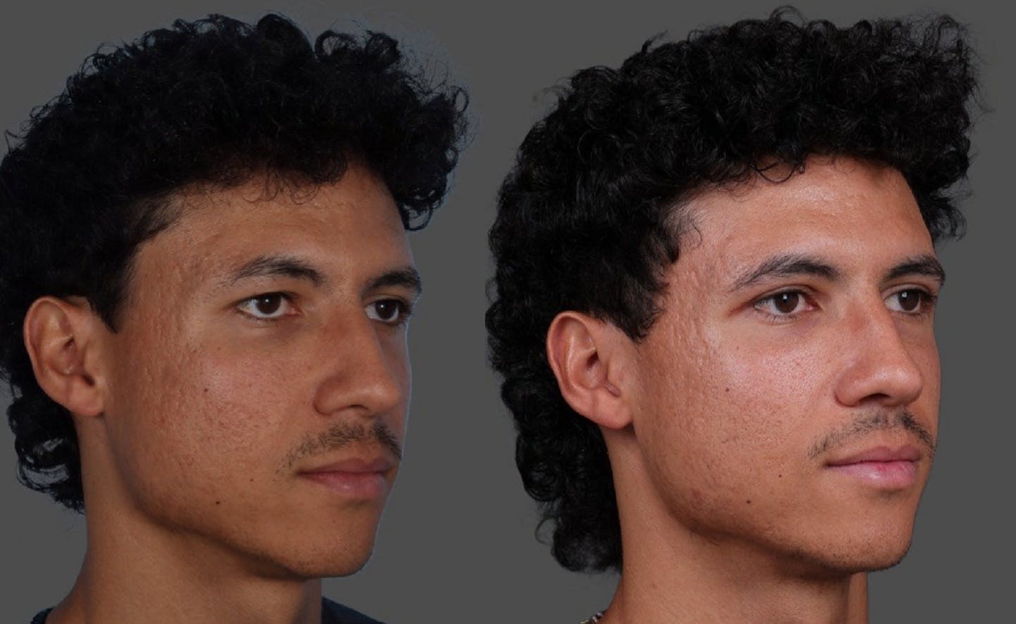 Eyelid Surgery (Blepharoplasty) Before & After Gallery - Patient 178420 - Image 2