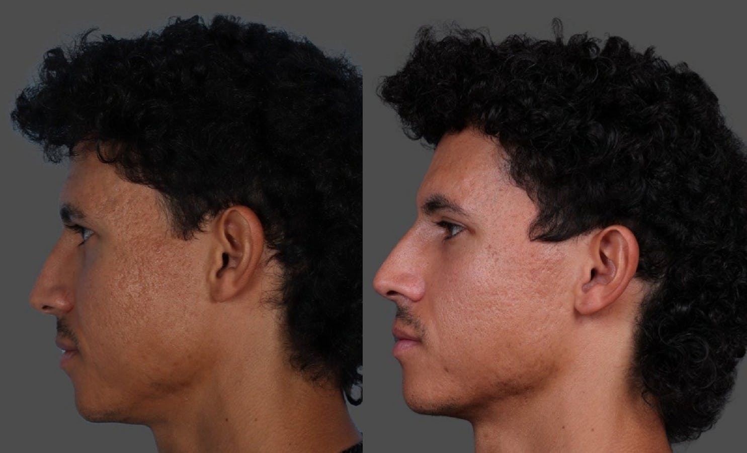 Eyelid Surgery (Blepharoplasty) Before & After Gallery - Patient 178420 - Image 5