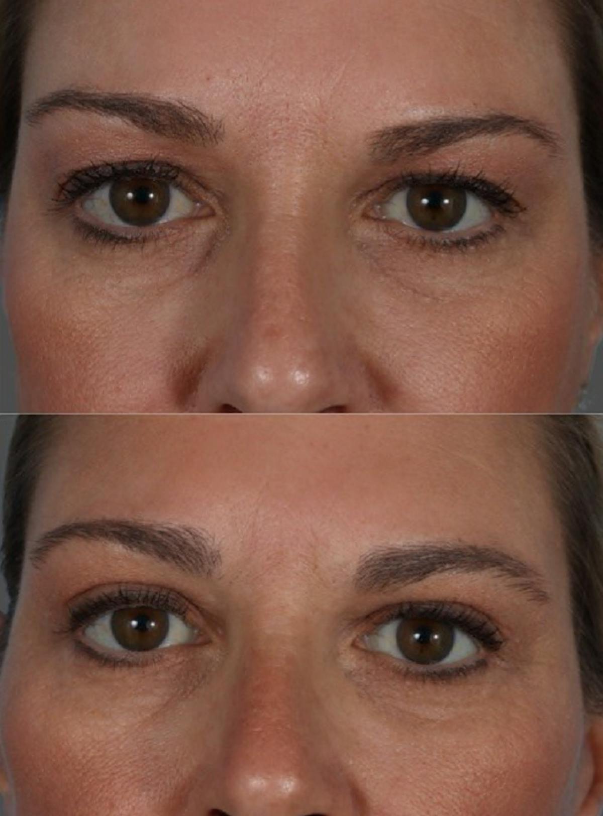 Limited Incision Facelift Before & After Gallery - Patient 135762 - Image 6