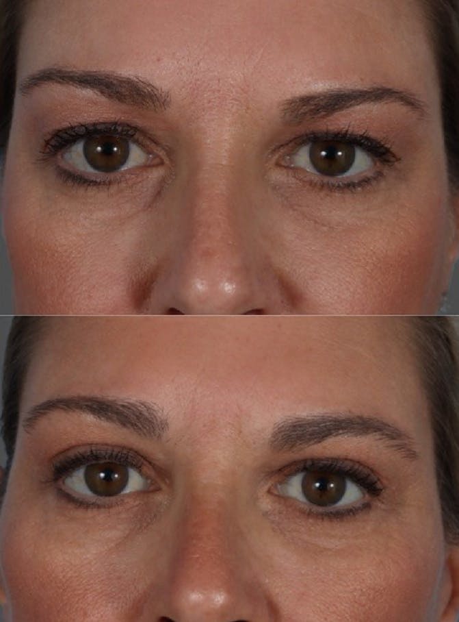 Submental Microliposuction Before & After Gallery - Patient 977444 - Image 6