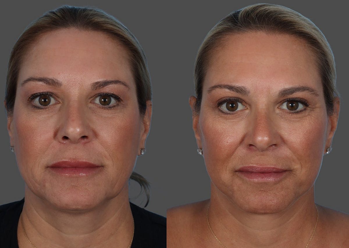 Limited Incision Facelift Before & After Gallery - Patient 135762 - Image 1