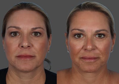 Eyelid Surgery (Blepharoplasty) Before & After Gallery - Patient 396789 - Image 1