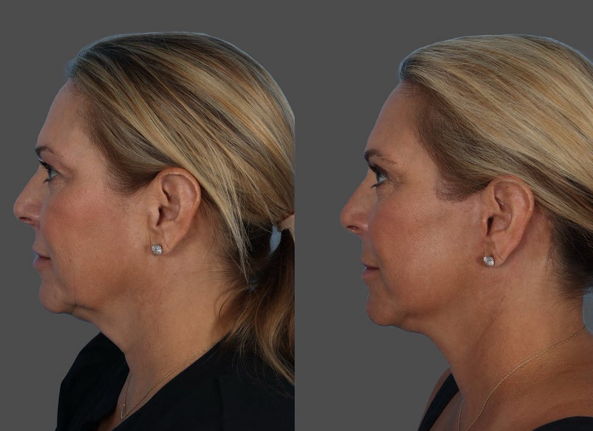 Limited Incision Facelift Before & After Gallery - Patient 135762 - Image 5