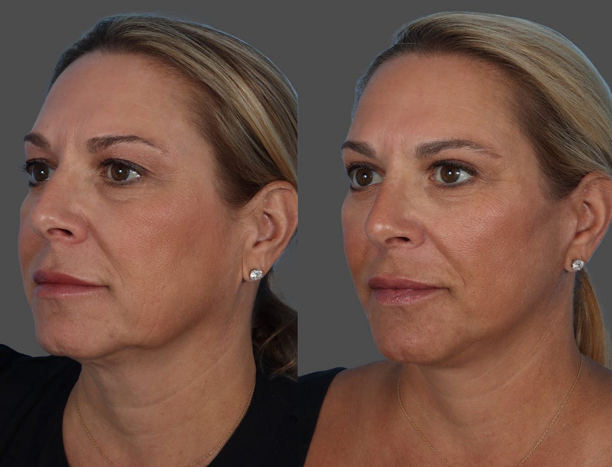 Limited Incision Facelift Before & After Gallery - Patient 135762 - Image 4