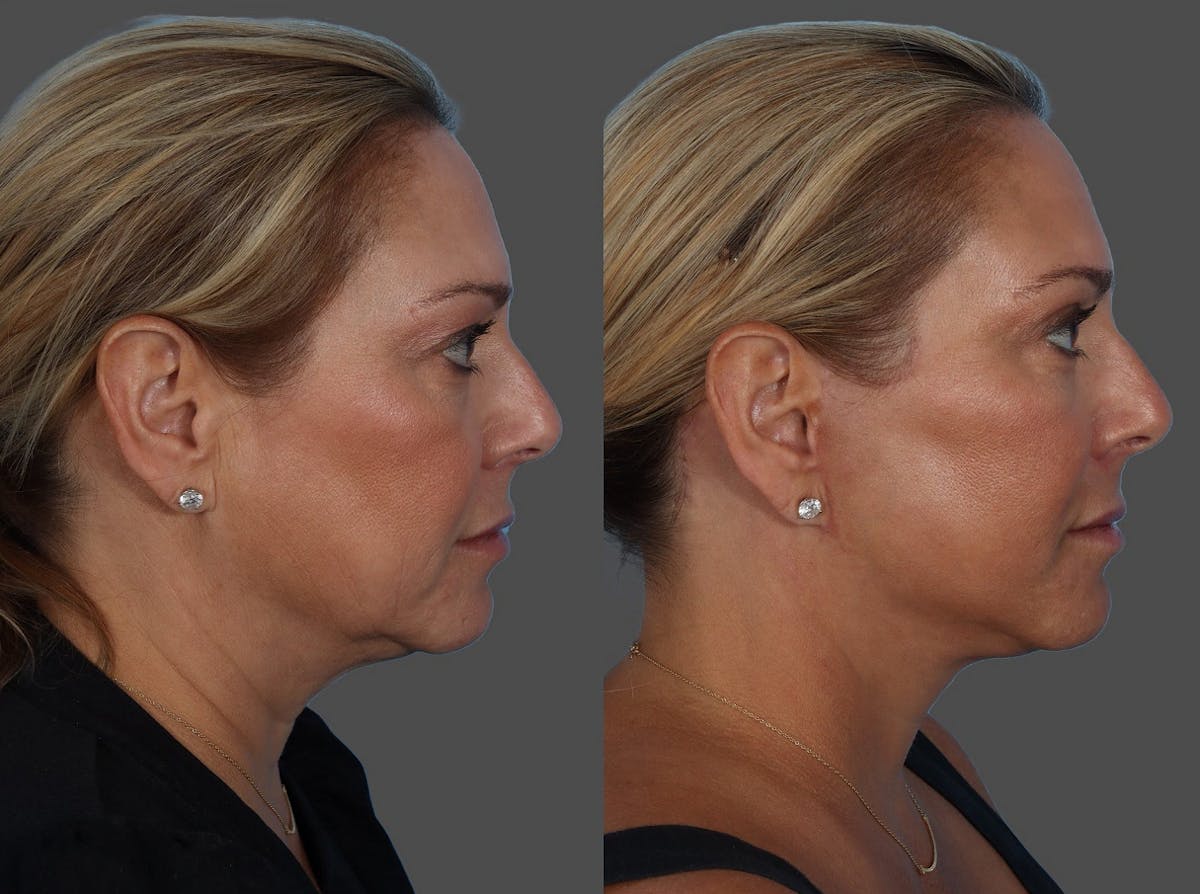 Limited Incision Facelift Before & After Gallery - Patient 135762 - Image 3