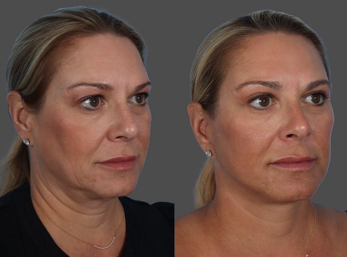 Limited Incision Facelift Before & After Gallery - Patient 135762 - Image 2