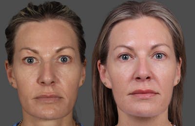 Eyelid Surgery (Blepharoplasty) Before & After Gallery - Patient 381958 - Image 1