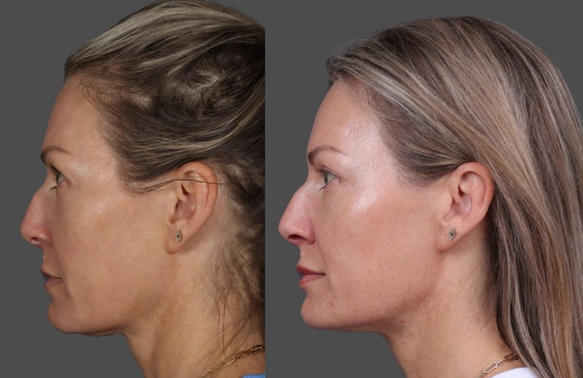 Eyelid Surgery (Blepharoplasty) Before & After Gallery - Patient 381958 - Image 5