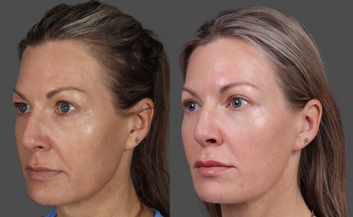 Eyelid Surgery (Blepharoplasty) Before & After Gallery - Patient 381958 - Image 4