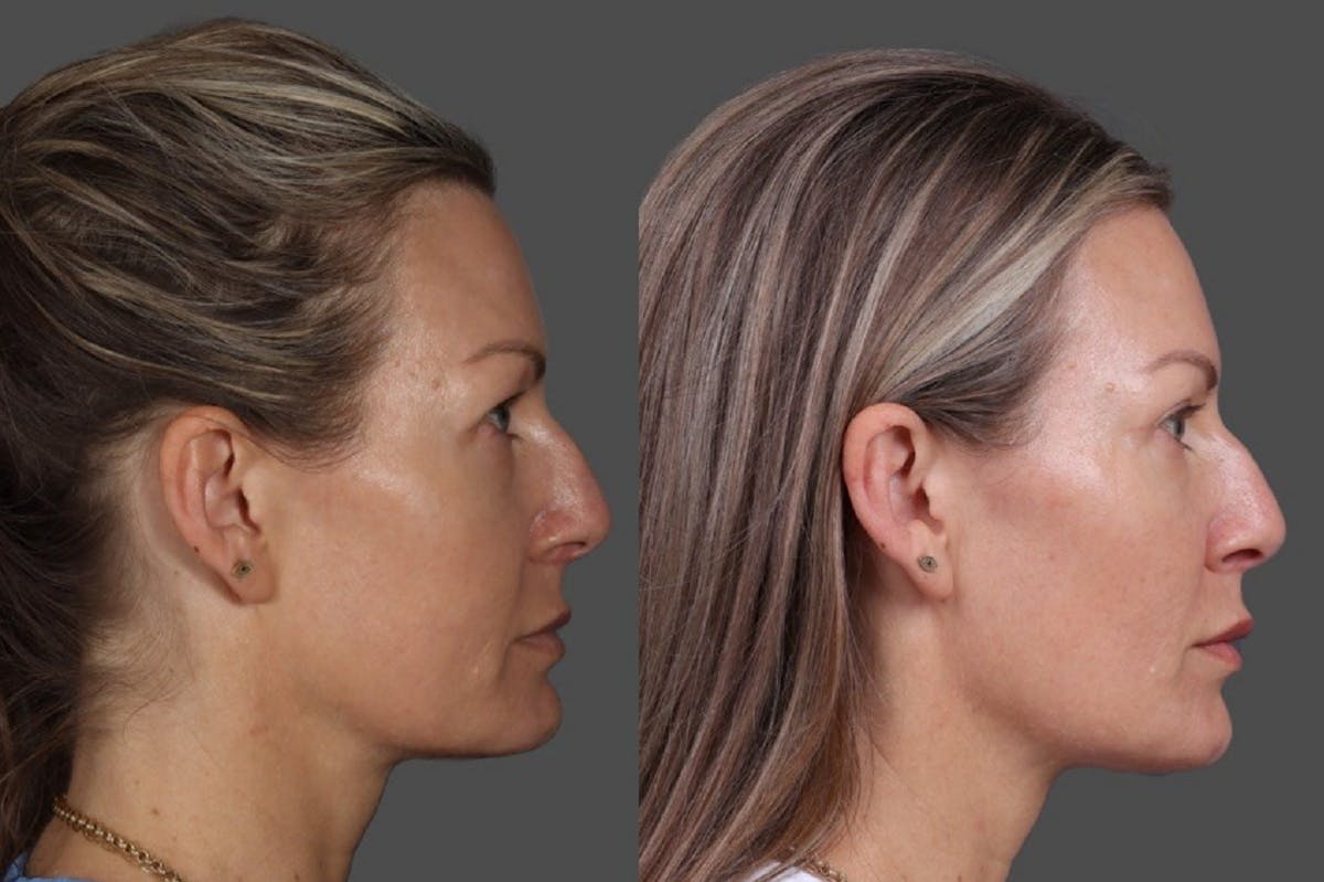 Eyelid Surgery (Blepharoplasty) Before & After Gallery - Patient 381958 - Image 3