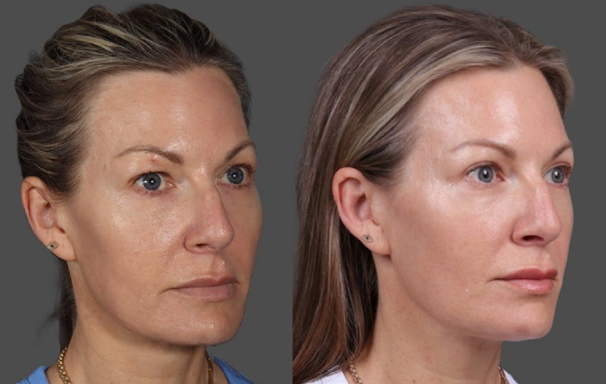 Eyelid Surgery (Blepharoplasty) Before & After Gallery - Patient 381958 - Image 2